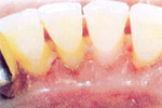 Zuby Posle ultrazvukovoy obrabotki