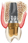 Chto takoe zubnoy implantat