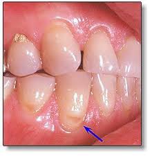 Деминерализация зубов, пример 2