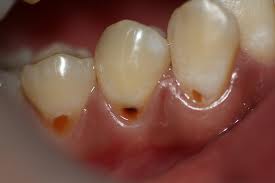 Деминерализация зубов, пример 3