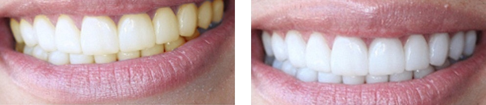 Отбеливание зубов системой AMAZING WHITE