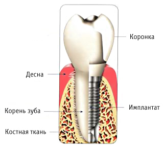 Имплантация в стоматологии
