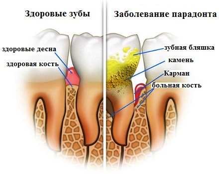 Как образуется зубной камень