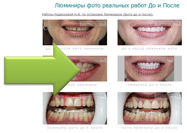 фото выравнивания зубов