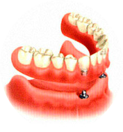 протезирование нижних зубов 