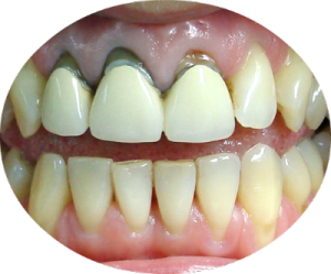 Протезирование передних зубов металокерамика
