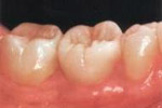 реставрация зубов вкладками