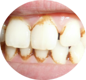 udalenie-zubnogo-kamnya